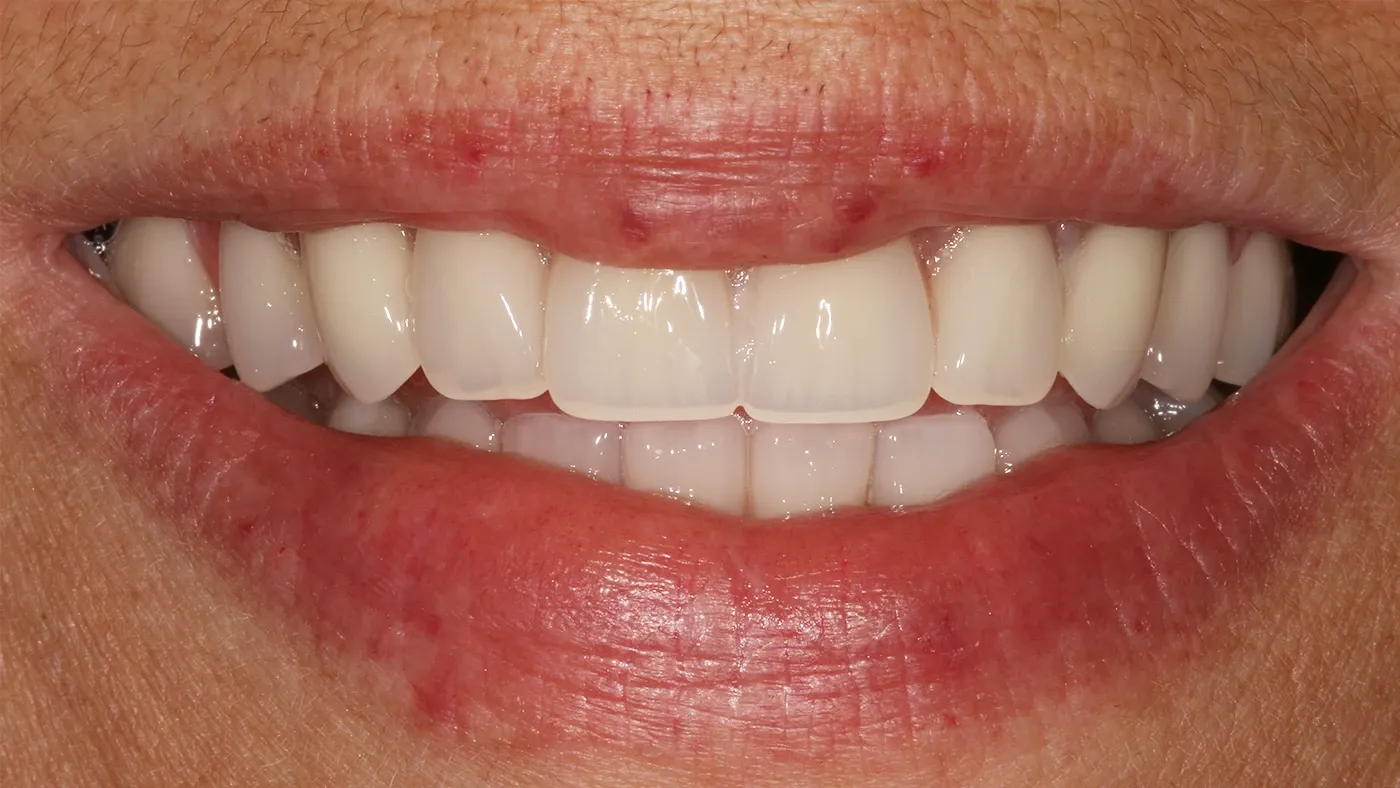 Smile case one after porcelain veneers and aligners at Broad Street Dental