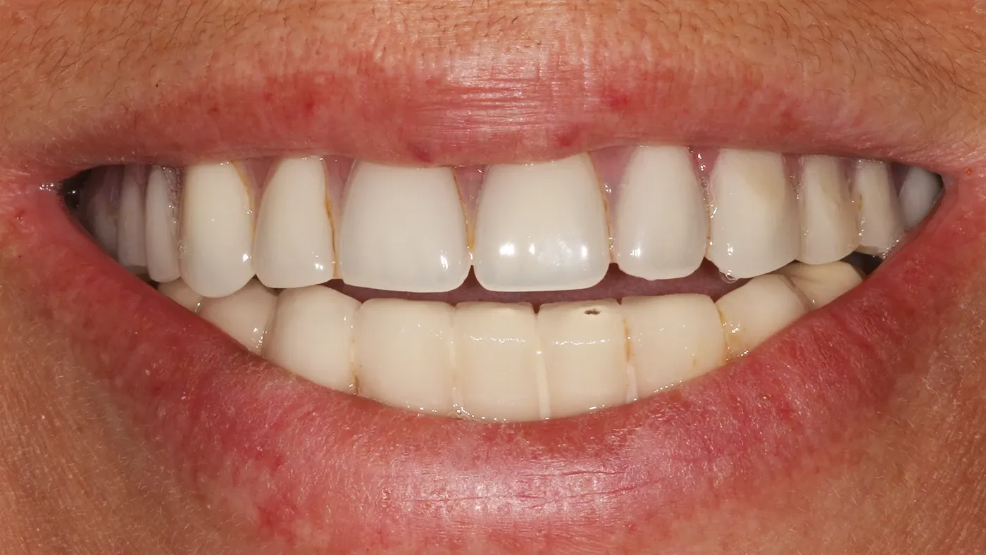 Smile case one before porcelain veneers and aligners at Broad Street Dental