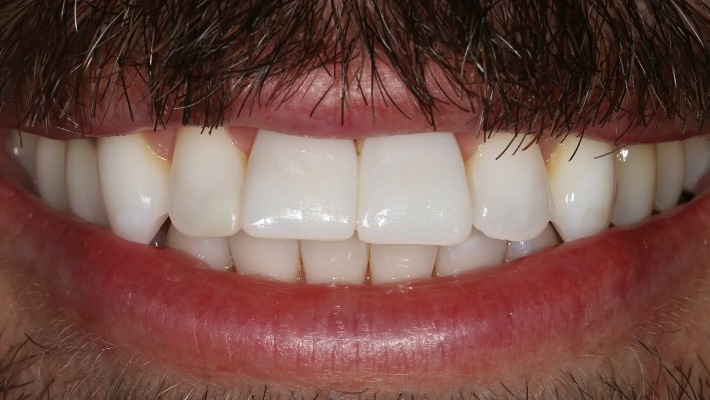 A Broad Street Dental patient smile after porcelain veneers and aligners